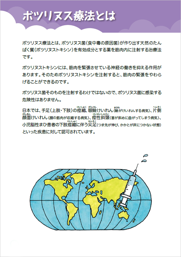 ボトックス療法